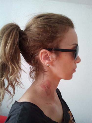 Arsa de coafeza, Annes se trateaza cu sange de vitel