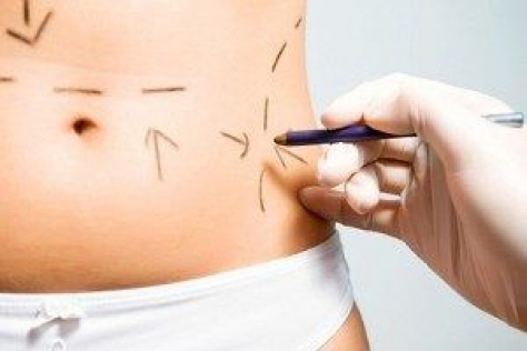 Femeia aflata in coma dupa liposuctie a murit