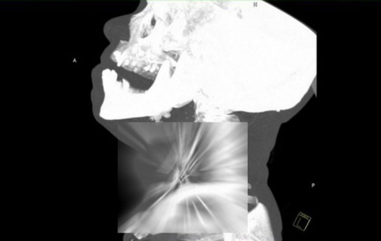 STUPEFIANT! Medicii au fost SOCATI de ceea ce au vazut in radiografia acestui barbat! (FOTO)