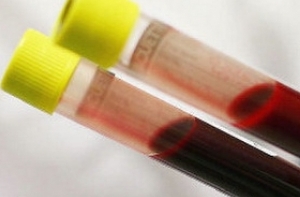 Situatie alarmanta: Suspiciune de transfuzie cu sange contaminat cu virus hepatic, la Slatina. Centrul de transfuzii, inchis