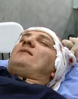 Mihai Traistariu, plin de sange! Si-a facut implant de par!