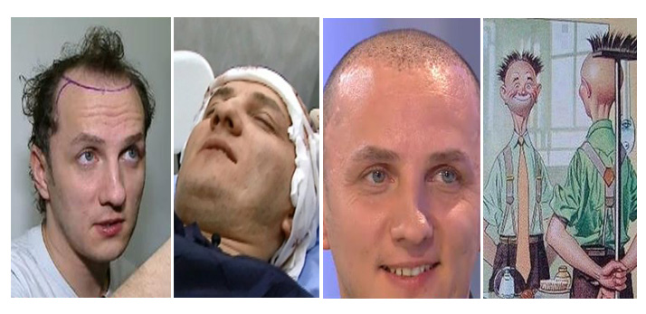 Traistariu si-a pus par! Cum arata dupa implant!