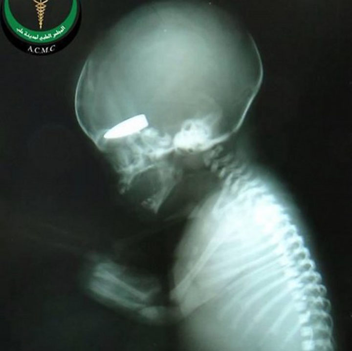 fetus shot - Ziarul National