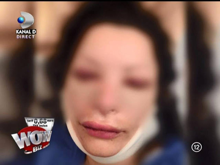 Cum a convins-o Ilie Nastase pe Brigitte Sfat sa isi scoata implanturile din buze
