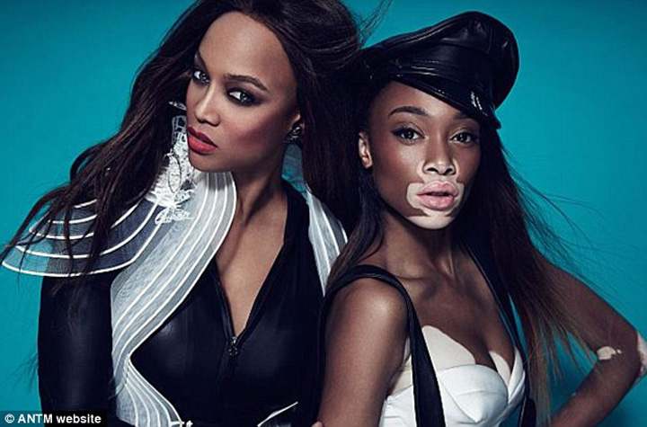 Desi are vitiligo, este pe cale sa devina cel mai bun model din America