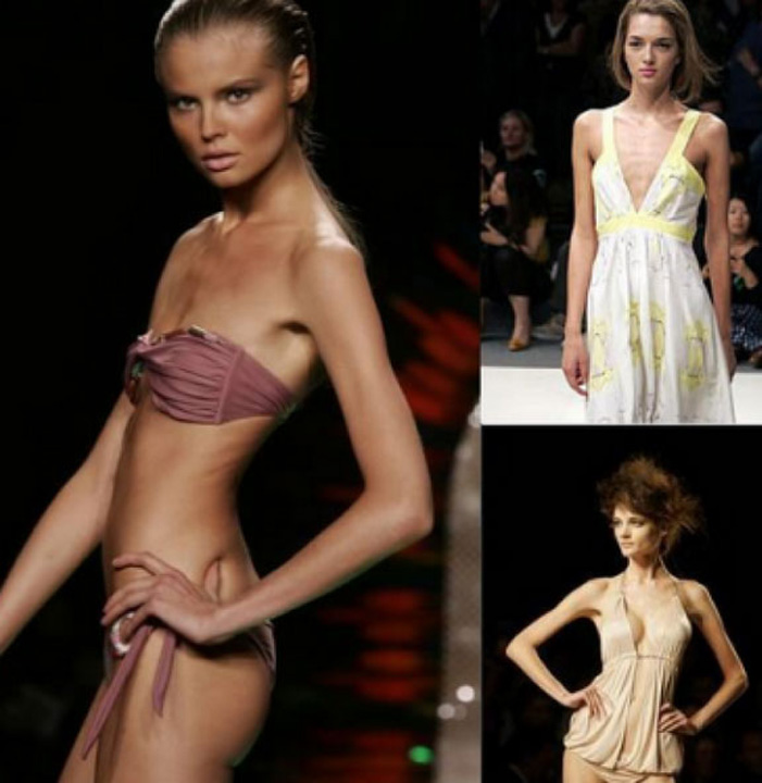 Amenda de 75.000 de euro si inchisoare de pana la 6 luni pentru cei care promoveaza anorexia!