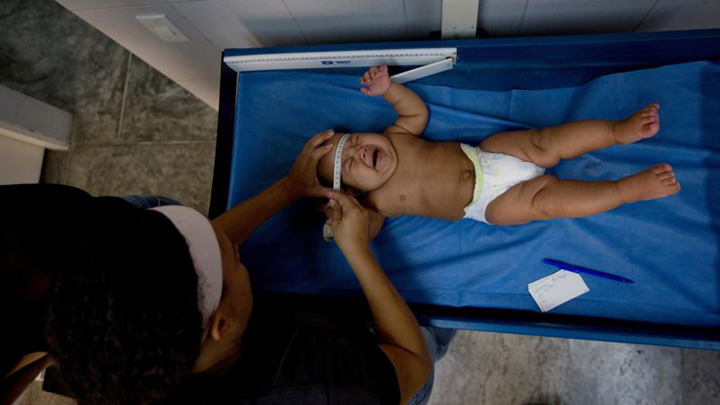 Zika, prima nastere a unui copil microcefal in Europa