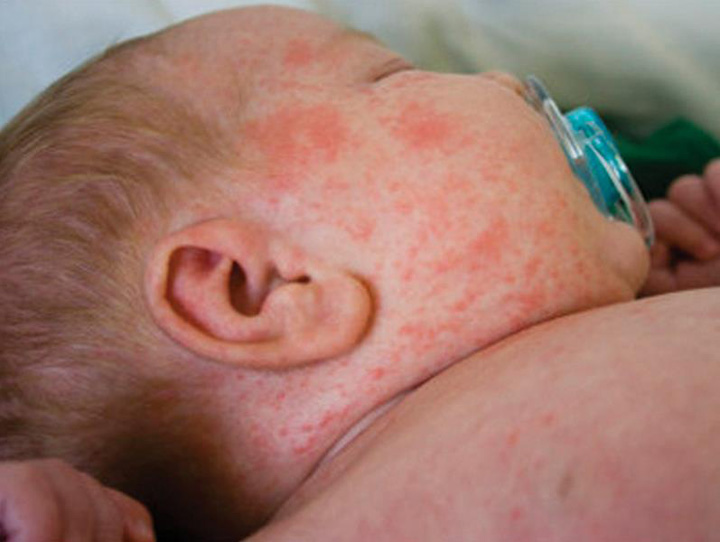 EPIDEMIA de rujeola: Focarele au aparut in comunitati de romi