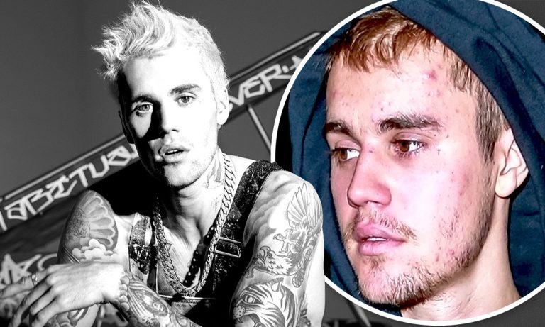 Justin Bieber suferă de boala Lyme