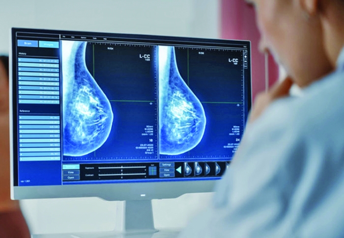Detectarea cancerului de sân. Inteligența artificială „vede” mai bine decât radiologii