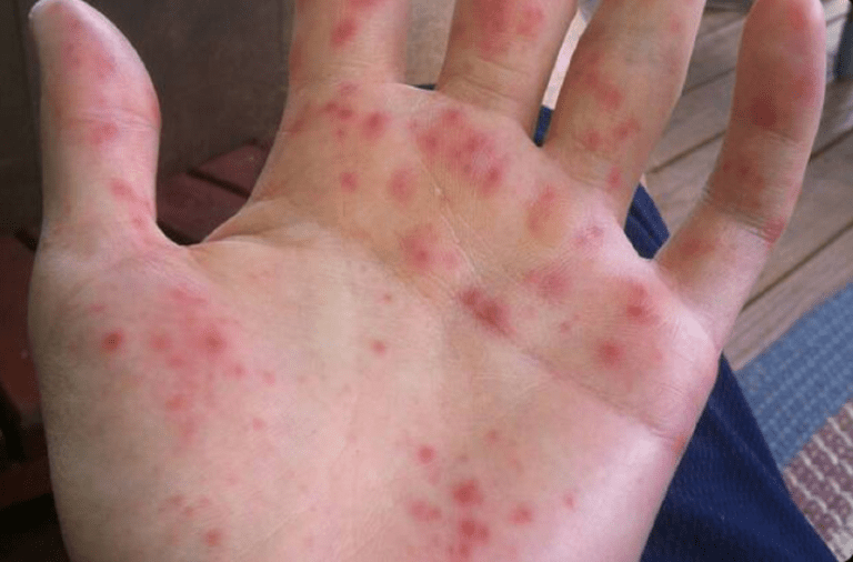 După Covid-19 și variola maimuței, o altă nenorocire. Ce este „gripa tomatelor” / „Foarte dureroasă și contagioasă”