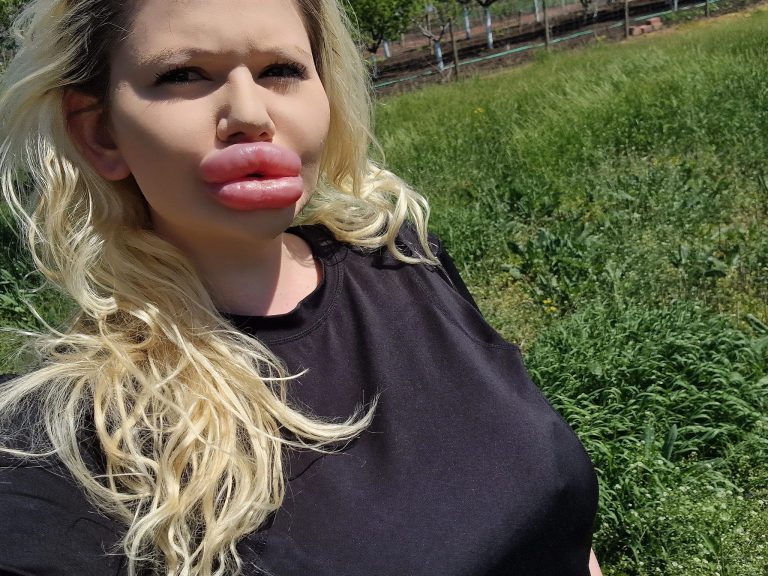 Femeia cu cele mai mari buze din lume și-a injectat și nasul, pentru a echilibra trăsăturile feței – FOTO
