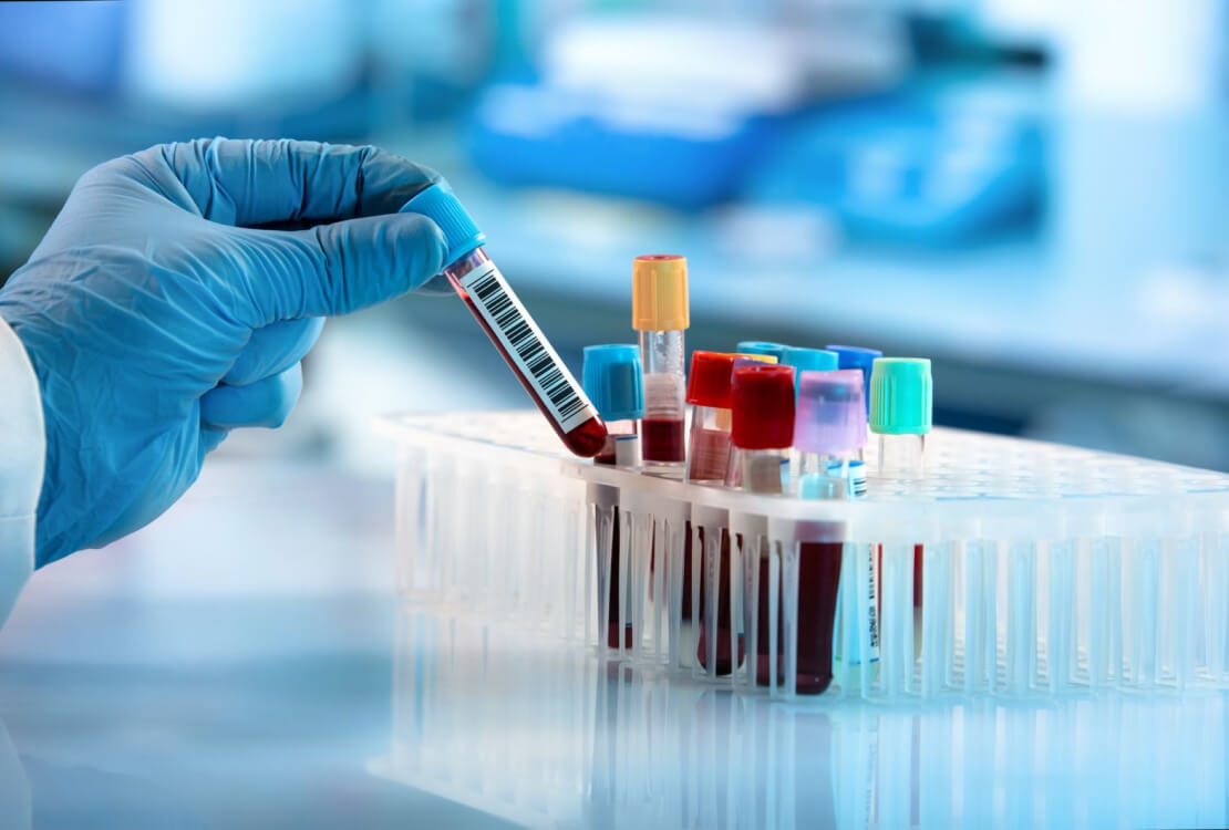 Jumătate dintre decesele cauzate de cancer pot fi prevenite, spune un nou studiu. Kilogramele în plus sunt un factor important