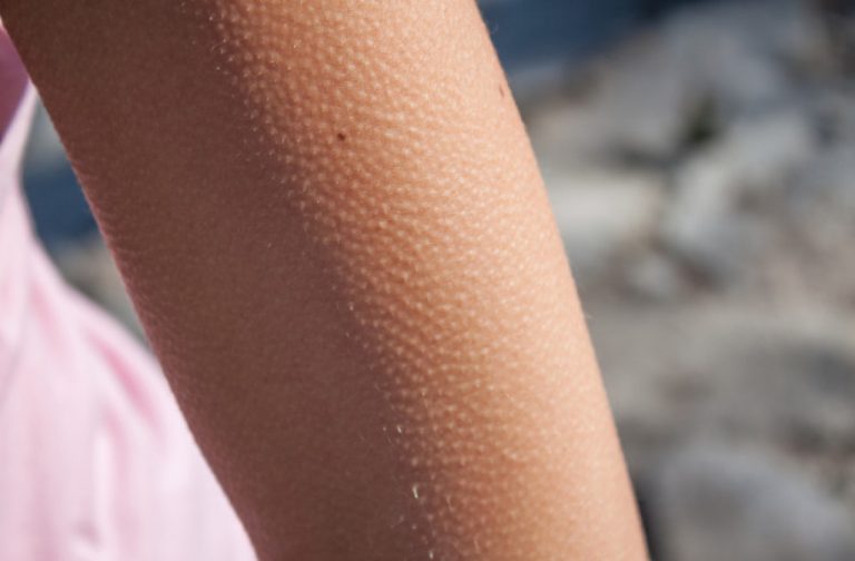 De ce avem pielea de găină? Răspunsuri evolutive și legătura cu emoțiile